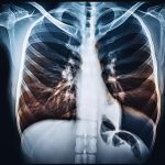 Asbestosis occurs when asbestos fibers are inhaled and get lodged in the lung tissue. Over time, these fibers cause lung tissue to scar, leading to stiffness and reduced lung function